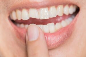 Person with a chipped tooth