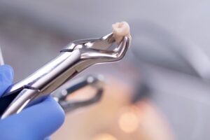 Dental tool holding extracted tooth. 